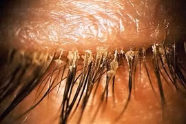 Tá hỏa khi phát hiện hơn 100 con giận làm tổ ở mắt