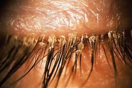 Tá hỏa khi phát hiện hơn 100 con giận làm tổ ở mắt