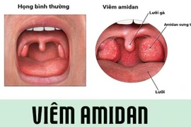 Viêm amidan mạn tính khi nào phẫu thuật?