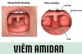 Viêm amidan mạn tính khi nào phẫu thuật?