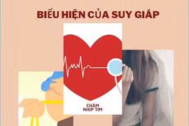 Người bị viêm tuyến giáp Hashimoto thường có biểu hiện của suy giáp.