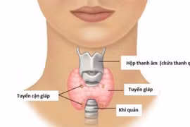 Tổn thương tuyến cận giáp