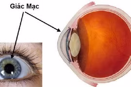 Viêm giác mạc sợi càng chữa càng khó nhìn