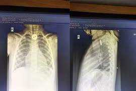 Trẻ hóc cúc áo vào đường thở