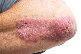 Bật mí giải pháp cải thiện bệnh vảy nến thể mảng hiệu quả tại nhà