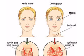 Điều trị bướu cổ đơn thuần khác bướu cổ Basedow