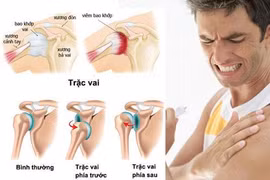 Điều trị lỏng khớp vai tái diễn