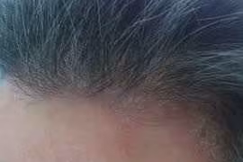 Khi bị nấm da đầu không nên ăn đồ dễ kích ứng