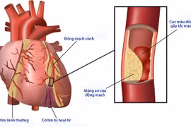 Đái tháo đường gây các bệnh tim mạch