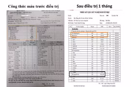 Phác đồ Lenalidomide – Dexamethasol liều thấp cứu bệnh nhân suy tủy do đa u tủy xương