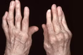 Nhận biết viêm khớp dạng thấp sớm để tránh tàn phế