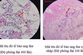 Mổ viêm ruột thừa xét nghiệm hóa ung thư