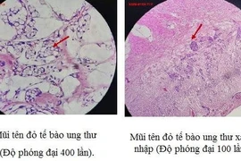 Mổ viêm ruột thừa xét nghiệm hóa ung thư