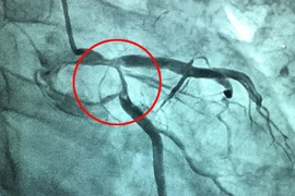 Nhồi máu cơ tim cấp do bệnh lý đa hồng cầu