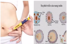 Nguy cơ khi kích trứng để sinh đôi