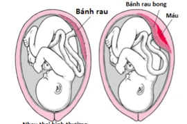 Sản phụ sức khỏe tốt vẫn bị rau bong non