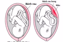 Sản phụ sức khỏe tốt vẫn bị rau bong non