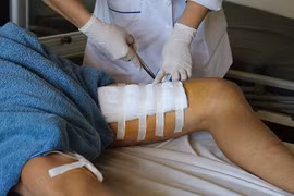 Bình rượu 20 lít phát nổ, người đàn ông bị đứt cơ chân