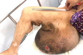 Bệnh viện Chợ Rẫy khám sàng lọc cho bệnh nhân bị u sợi thần kinh