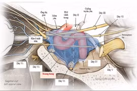 Đã cứu sống được u máu trong xoang tĩnh mạch hang