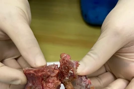 Y học Việt lần đầu ra tay triệt căn u cột sống