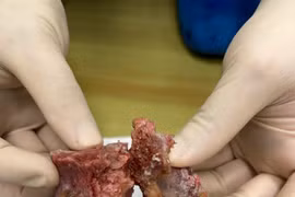 Y học Việt lần đầu ra tay triệt căn u cột sống