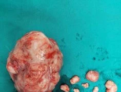  Quá nhiều nhân xơ vì để lâu không điều trị