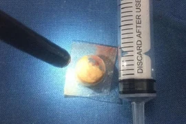 Gắp viên thuốc còn nguyên vỏ nằm trong khí quản 3 năm