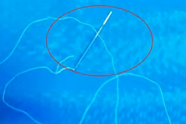 Kinh hãi cảnh bé 12 tuổi nuốt kim khâu, sợi cước dài 30cm vào bụng