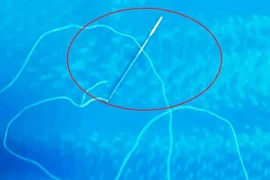 Kinh hãi cảnh bé 12 tuổi nuốt kim khâu, sợi cước dài 30cm vào bụng