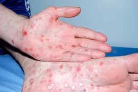 Tình dục không an toàn, nam bệnh nhân nổi ban vùng thân