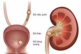 Sạch sỏi chớ nên chủ quan