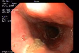 Loét thực quản vì gây nôn chữa mỡ máu