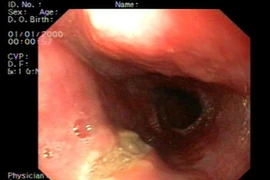 Loét thực quản vì gây nôn chữa mỡ máu