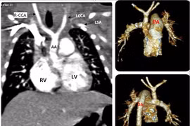 Gián đoạn quai động mạch chủ ở trẻ.