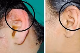 Khuyết tật nghe nói có phẫu thuật được không?