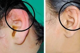 Khuyết tật nghe nói có phẫu thuật được không?