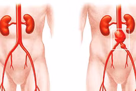 Đặt stent graft điều trị bệnh lý động mạch chủ bụng