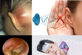 Khám phá hệ vi sinh vật có thể giúp ngăn ngừa bệnh viêm tai giữa