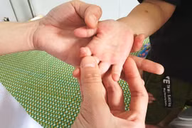 Bệnh nhân mắc tay chân miệng ở Quảng Nam tăng đột biến