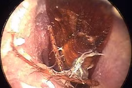 Cấp cứu vì gián trong tai