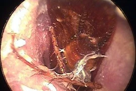 Cấp cứu vì gián trong tai