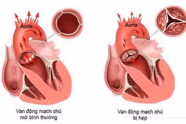 Xơ cứng và hẹp van động mạch chủ