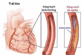 Bệnh động mạch ngoại biên