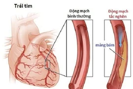 Bệnh động mạch ngoại biên