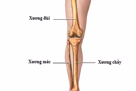 Sốc sau chấn thương cẳng chân