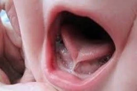 Nhiễm trùng sàn miệng nghiêm trọng do lấy gai bưởi chữa chậm nói