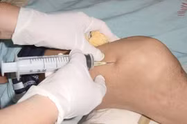 Các phương pháp tiêm điều trị thoái hóa khớp gối