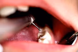 Nghiên cứu mới này sẽ khiến bạn không bao giờ dám quên đánh răng nữa