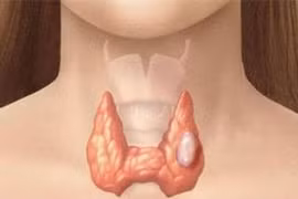 Mổ nội soi và mổ mở tuyến giáp